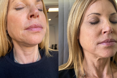 Juvederm before and after photo