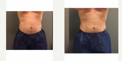 CoolSculpting before and after photo