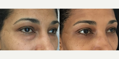 Eyelid Surgery before and after photo