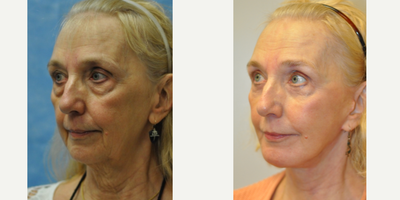 Facelift before and after photo