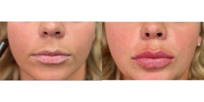 Lip Fillers before and after photo