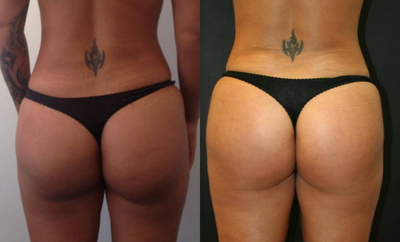 Brazilian Butt Lift before and after photo