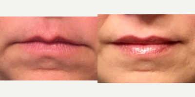 Dermal Fillers before and after photo