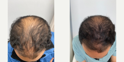 Hair Loss Treatment before and after photo