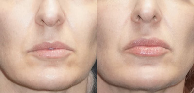 Volbella before and after photo