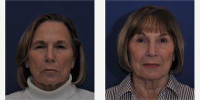 Brow Lift before and after photo