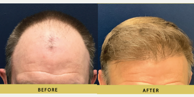 Hair Loss Treatment before and after photo