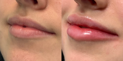 Lip Fillers before and after photo