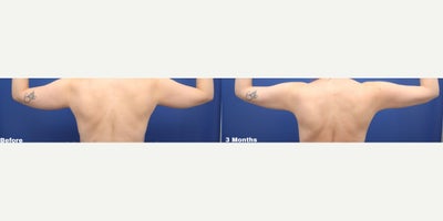 Tumescent Liposuction before and after photo