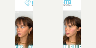 Cheek Fillers before and after photo
