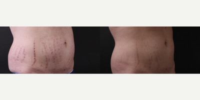 CoolSculpting before and after photo