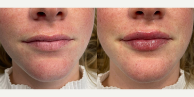 Volbella before and after photo