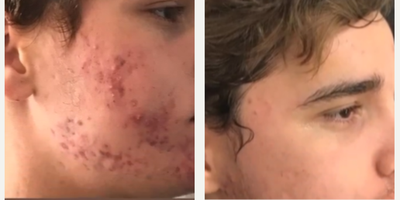 AviClear before and after photo