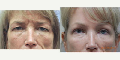 Eyelid Surgery before and after photo