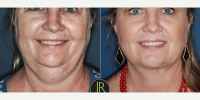 Liposuction before and after photo