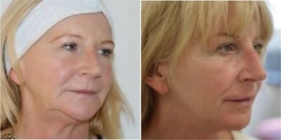 Nonsurgical Facelift before and after photo