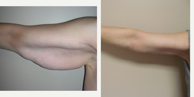 Arm Lift before and after photo