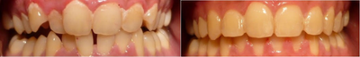 Braces before and after photo