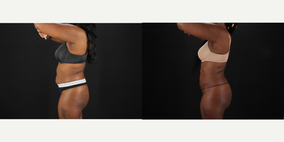Brazilian Butt Lift before and after photo