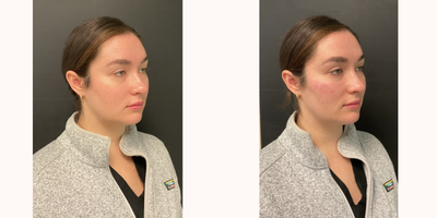 Dermal Fillers before and after photo