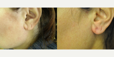 Earlobe Repair before and after photo