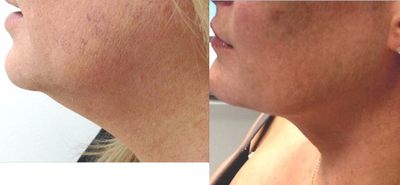 Kybella before and after photo