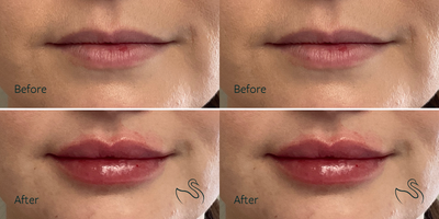 Lip Fillers before and after photo