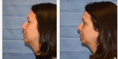 Rhinoplasty before and after photo