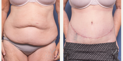 Tummy Tuck before and after photo