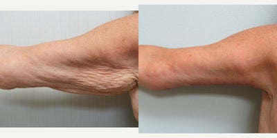 Arm Lift before and after photo