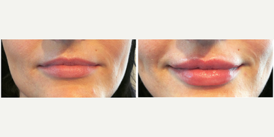 Dermal Fillers before and after photo