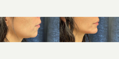 Dermal Fillers before and after photo