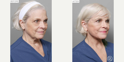 Facelift before and after photo