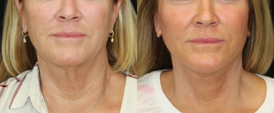 Lower Facelift before and after photo