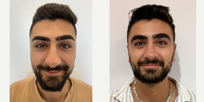 Revision Rhinoplasty before and after photo