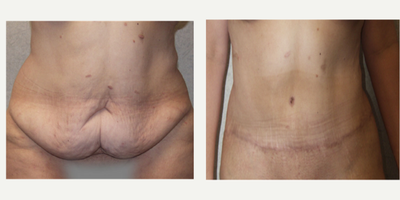 Tummy Tuck before and after photo