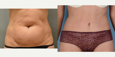 Tummy Tuck before and after photo