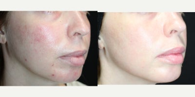 UltraClear Laser before and after photo