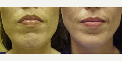Botox before and after photo