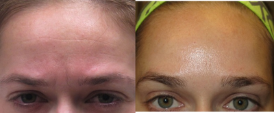 Botox before and after photo