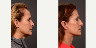 Facelift before and after photo
