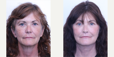 Lip Lift before and after photo