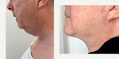 Smart Lipo before and after photo