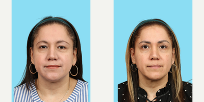 Buccal Fat Removal before and after photo