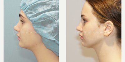 Buccal Fat Removal before and after photo