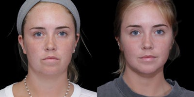 Chin Implant before and after photo
