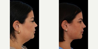 Chin Liposuction before and after photo