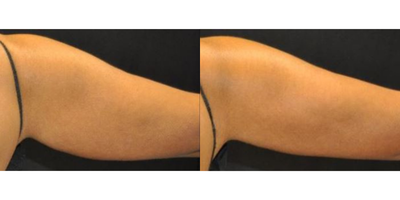 CoolSculpting before and after photo