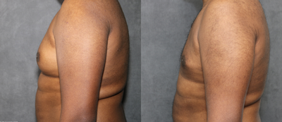 Gynecomastia Surgery before and after photo