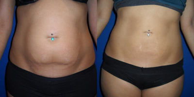 Liposuction before and after photo